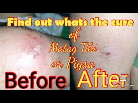 matag tiki symptoms|Boils: Causes, Symptoms, and Treatment .